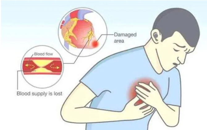 Heart Stents:the starting point,not ending point